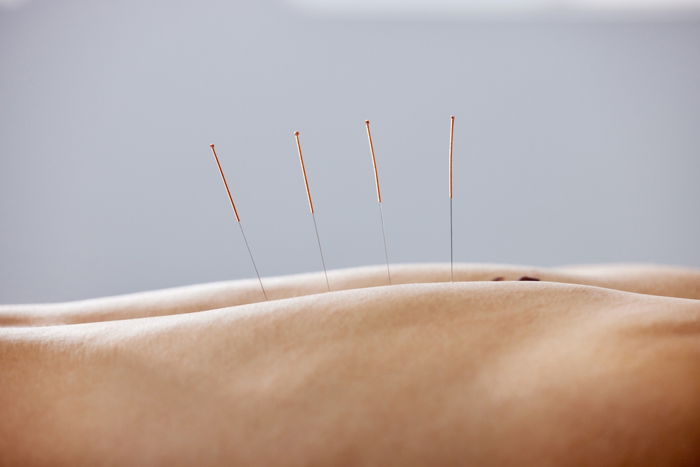 Acupuncture
